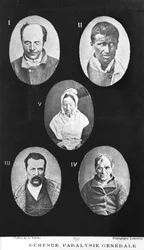 Dementia, General Paralysis, Illustration from Nouveau Traite Elementaire et Pratique des Maladies Mentales by Henri Dagonet